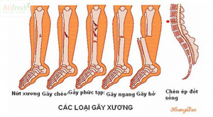 Gãy xương